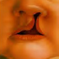 Cleft lip
